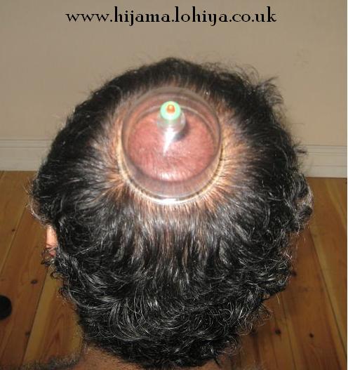 Head Cupping - Crown Point - Hijama Cupping London